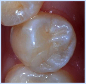 dental-fillings1
